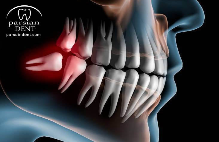 آنچه درباره دندان عقل و زمان کشیدن آن باید بدانیم؟