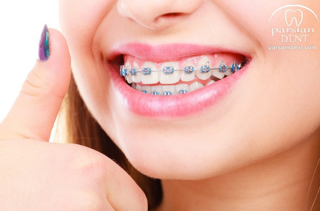 بهداشت دندان در ارتودنسی شامل چه نکاتی میشود