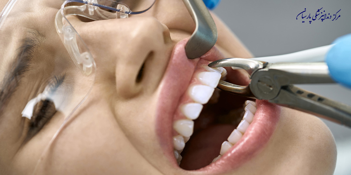 از-مراقبت-بعد-از-کشیدن-دندان-چه-نکاتی-را-میدایند-؟