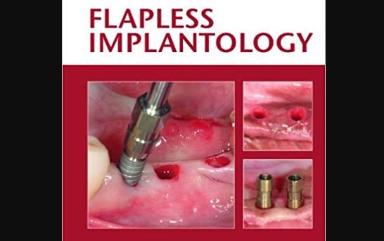 ایمپلنت به روش پانچ چیست ؟