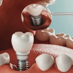 بایدها-و-نبایدهایی-از-مراقبت-بعد-از-ایمپلنت-دندان
