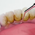 بایدها-و-نبایدهایی-از-مراقبت-بعد-از-جرمگیری-دندان-که-باید-بدانید