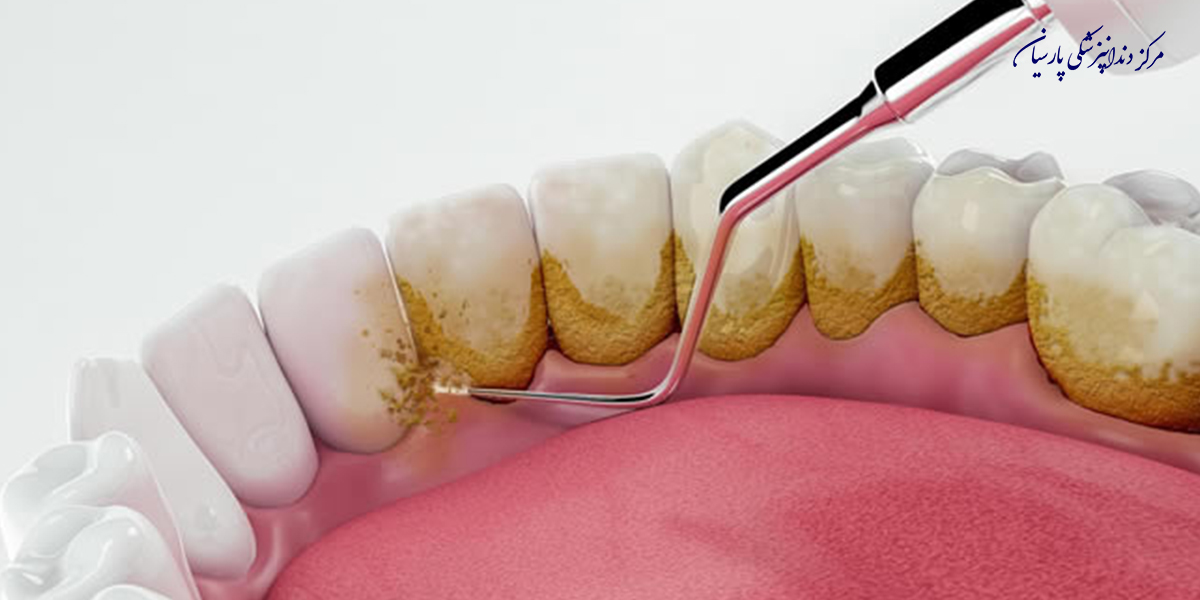 بایدها-و-نبایدهایی-از-مراقبت-بعد-از-جرمگیری-دندان-که-باید-بدانید