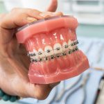 برای-مراقبت-از-ارتودنسی-دندان-باید-چه-نکاتی-را-رعایت-کنیم