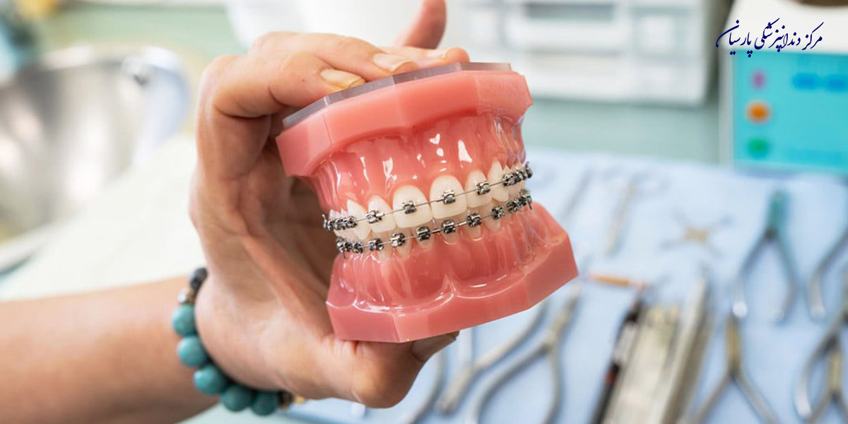 برای-مراقبت-از-ارتودنسی-دندان-باید-چه-نکاتی-را-رعایت-کنیم