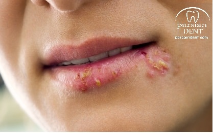 تبخال چیست و چگونه درمان می شود ؟