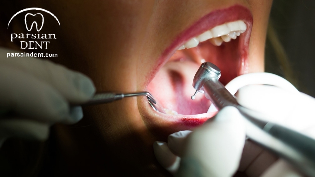 ترمیم پوسیدگی دندان چرا و چگونه انجام می شود ؟