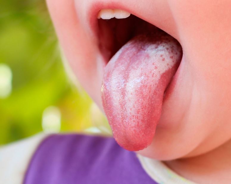 درمان برفک دهان