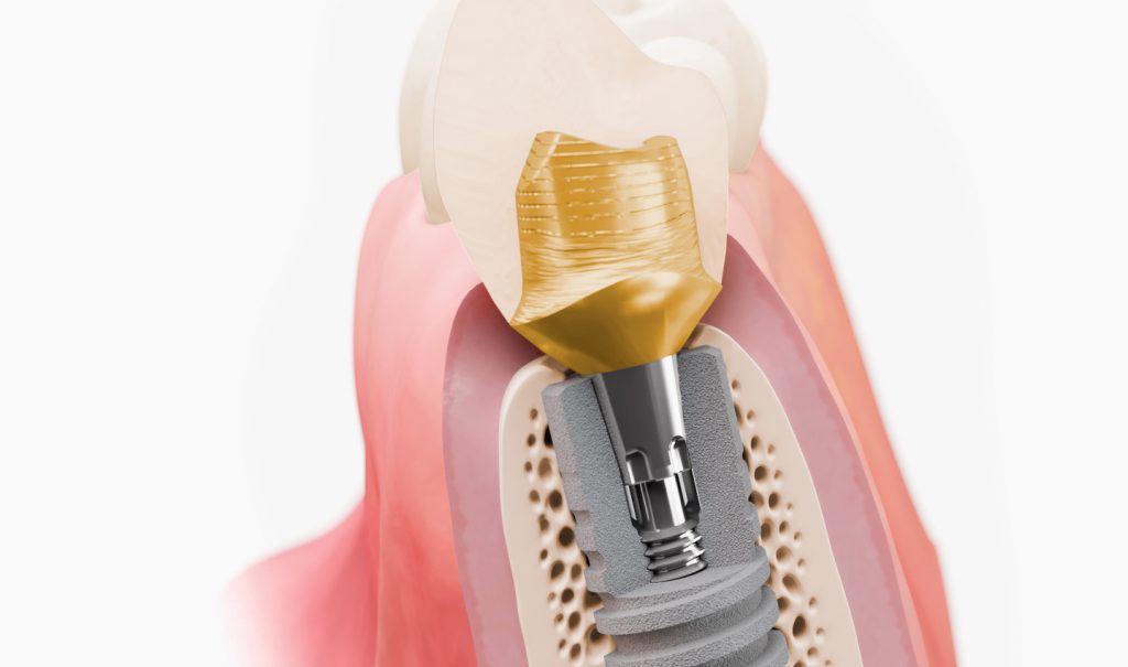روند جراحی ایمپلنت دندان هرآنچه باید درباره آن بدانید!
