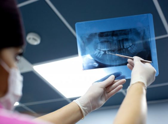 عصب کشی دندان چیست و چطور انجام می شود؟