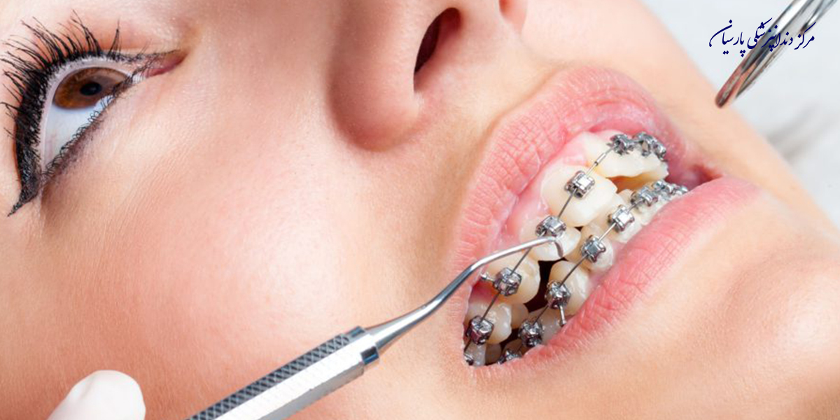 مراقبت-از-ارتودنسی-دندان-به-چه-صورتی-است-؟