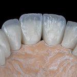 مراقبت-از-دندان-روکش-شده-بایدها-و-نبایدهایی-که-لازم-است-بدانید