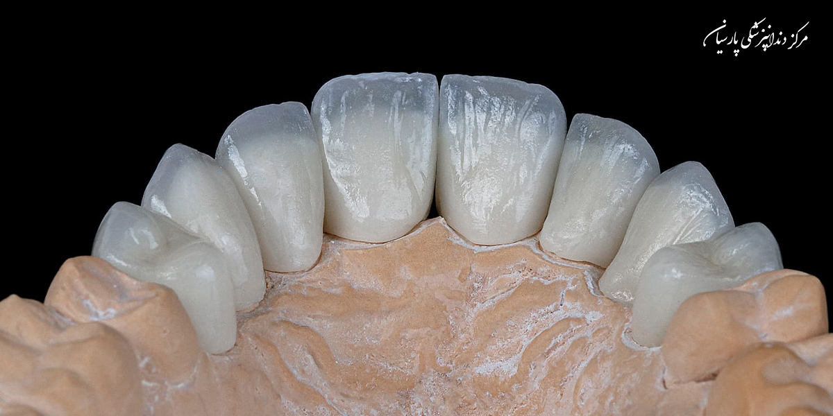 مراقبت-از-دندان-روکش-شده-بایدها-و-نبایدهایی-که-لازم-است-بدانید