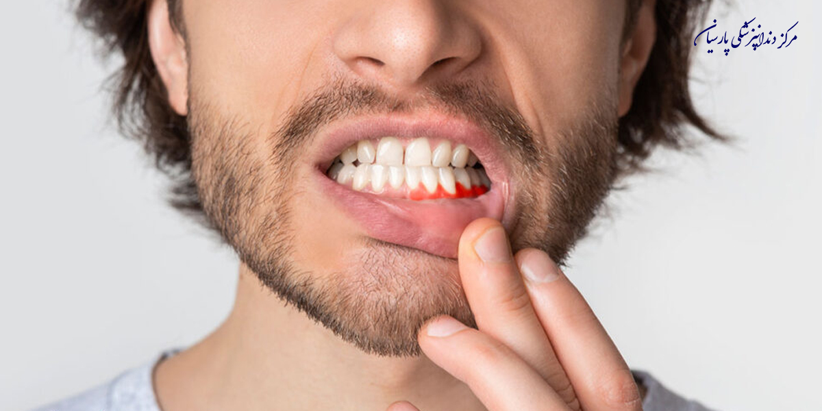 مراقبت-بعد-از-جراحی-لثه-بایدها-و-نبایدهایی-که-لازم-است-بدانید