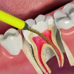 مراقبت-بعد-از-عصب-کشی-دندان-و-نکات-طلایی-که-لازم-است-در-مورد-آن-بدانید