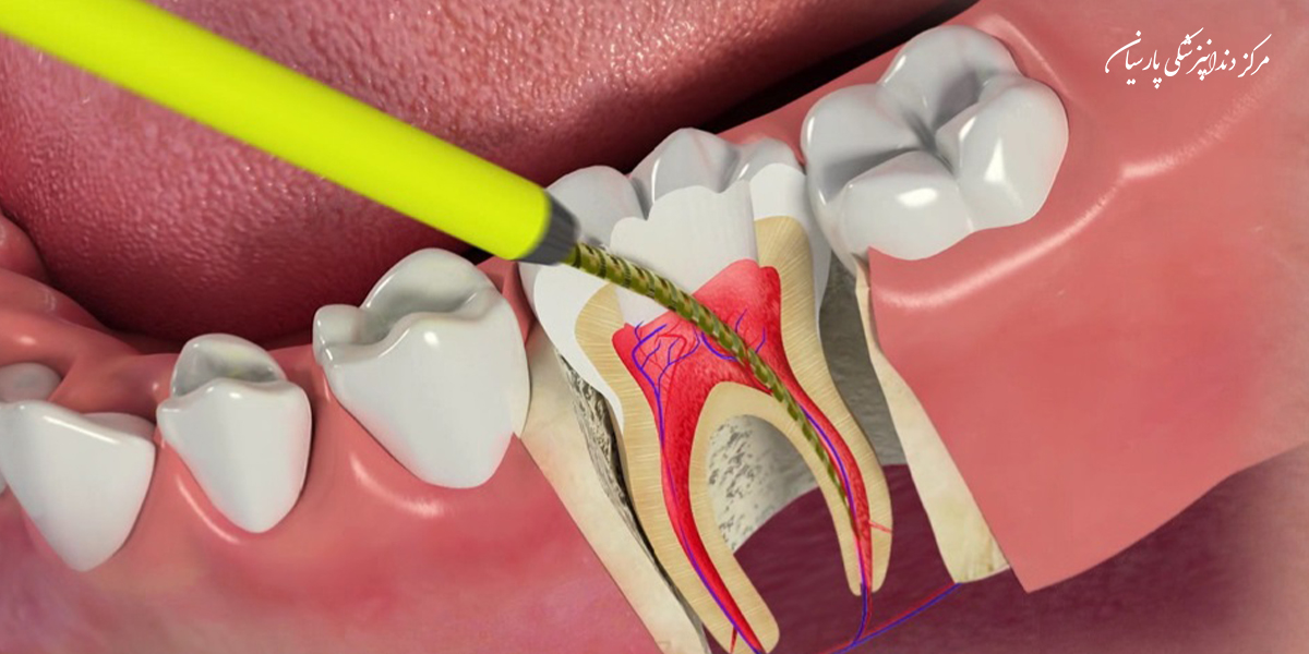 مراقبت-بعد-از-عصب-کشی-دندان-و-نکات-طلایی-که-لازم-است-در-مورد-آن-بدانید