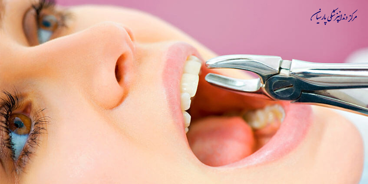 مراقبت-بعد-از-کشیدن-دندان-بایدها-و-نبایدهایی-که-لازم-است-بدانید