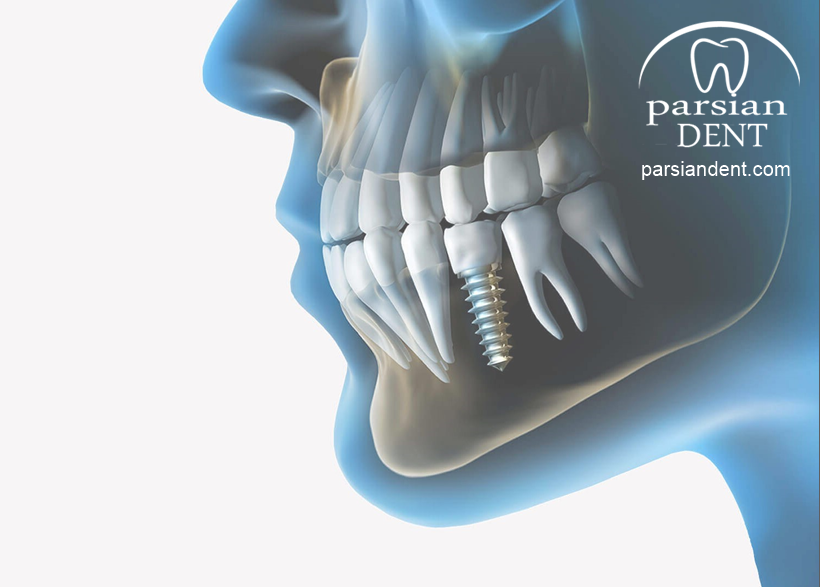 مزایا و معایب ایمپلنت دندان