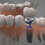 نکات-طلایی-مراقبت-بعد-از-ایمپلنت-دندان