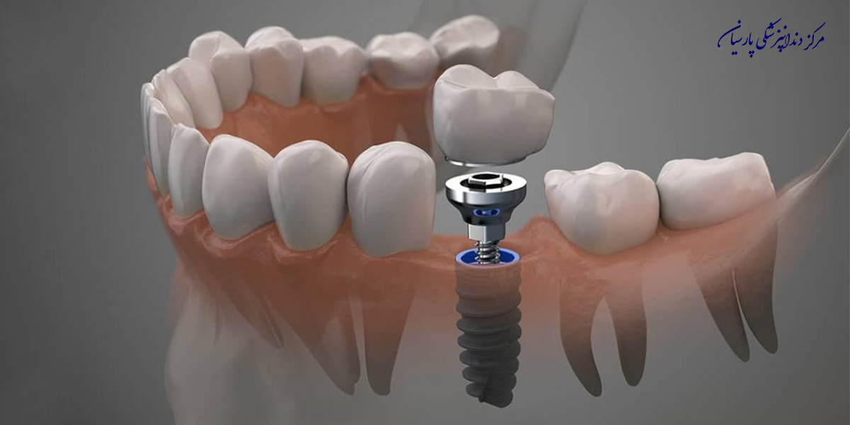 نکات-طلایی-مراقبت-بعد-از-ایمپلنت-دندان