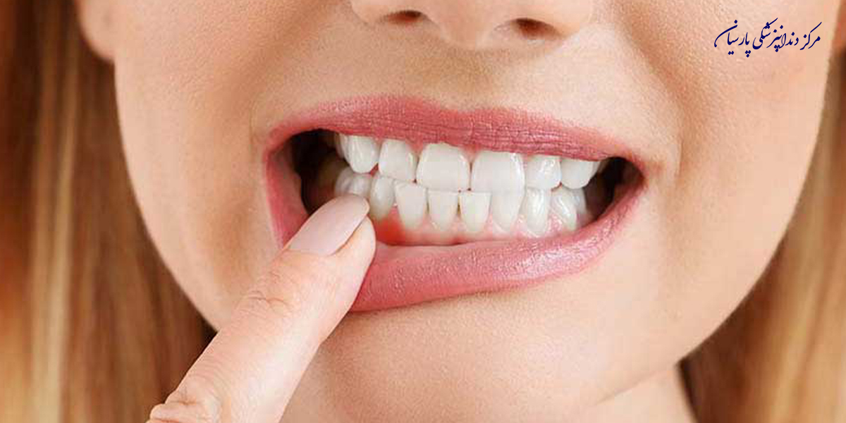 نکات-طلایی-که-باید-از-مراقبت-بعد-از-جراحی-لثه-بدانید