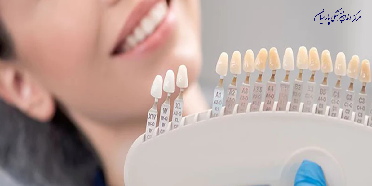 نکاتی-طلایی-دشر-مورد-مراقبت-از-لمینت-دندان