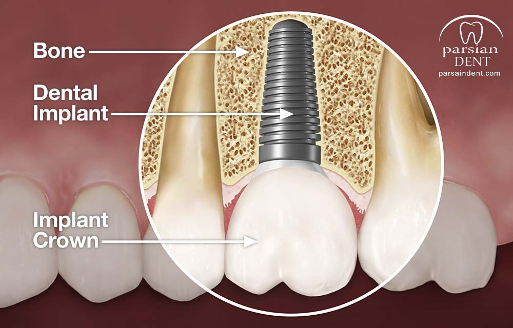 همه چیز درباره ایمپلنت دندانی