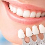 همه-چیز-دررابطه-با-مراقبت-از-لمینت-دندان