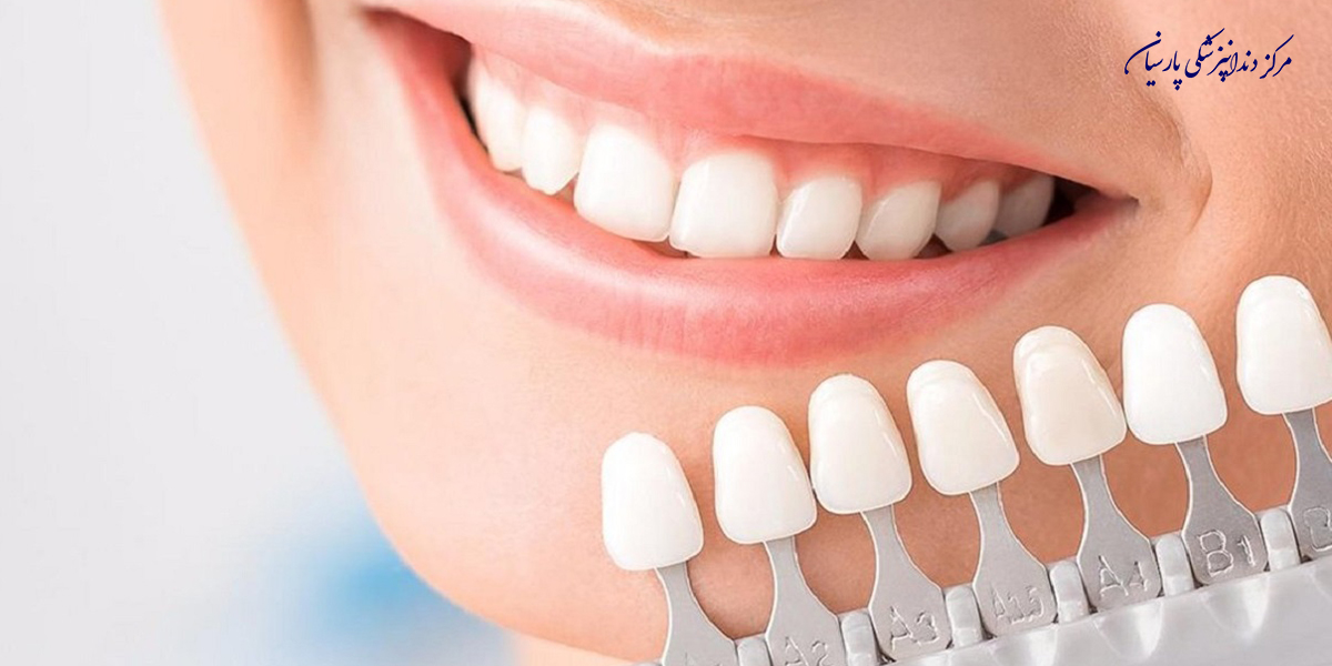 همه-چیز-دررابطه-با-مراقبت-از-لمینت-دندان