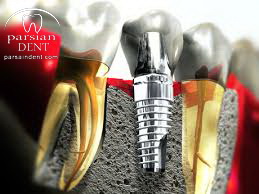 چه عواملی در تعیین هزینه ایمپلنت تاثیرگذار هستند؟