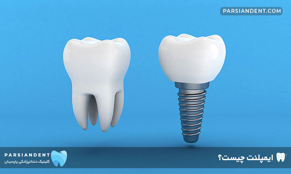 ایمپلنت چیست؟