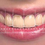 بایدها و نبایدهایی از طرح لبخند که باید بدانید