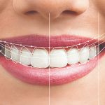 طرح لبخند شامل چه مواردی است ؟