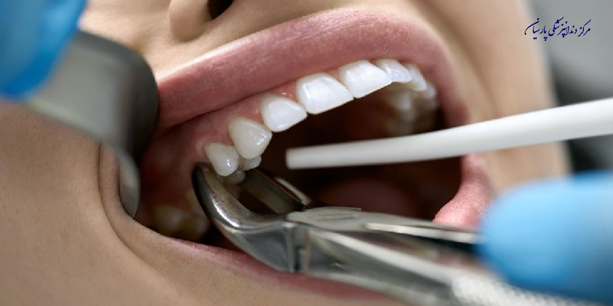 کشیدن دندان برای کدام دندان‏ها لازم است ؟