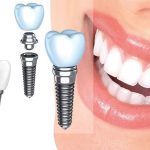 آیا میتوان درد جراحی ایمپلنت را تجمل کرد ؟