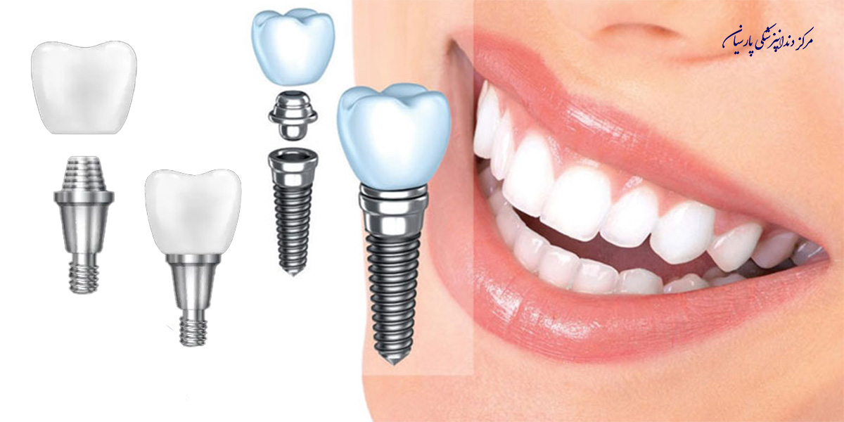 آیا میتوان درد جراحی ایمپلنت را تجمل کرد ؟