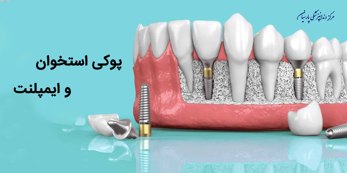 آیا پوکی استخوان و ایمپلنت با هم ارتباط دارند ؟