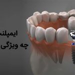 ایمپلنت دندان چه ویژگی هایی دارد ؟