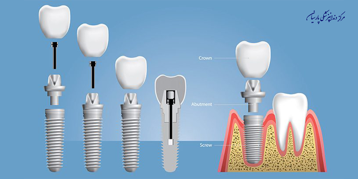 بایدها و نبایدهایی از ایمپلنت دندان که باید بدانید