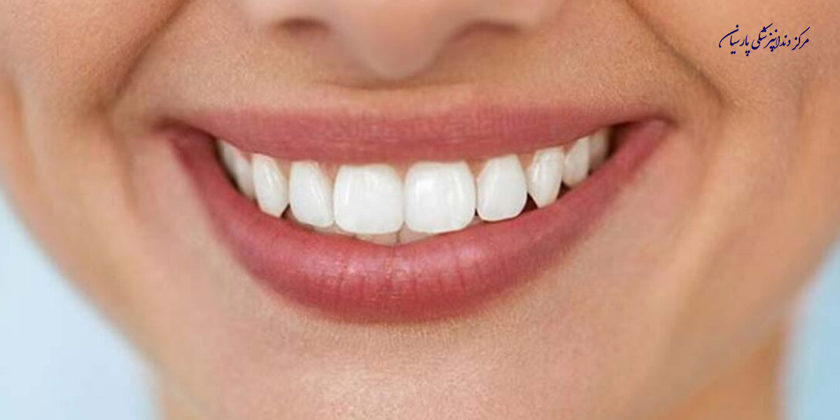 ویژگی های مهم طرح لبخند هالیوودی کدام است ؟