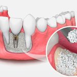 چه رابطه ای بین پوکی استخوان و ایمپلنت دندان وجود دارد ؟