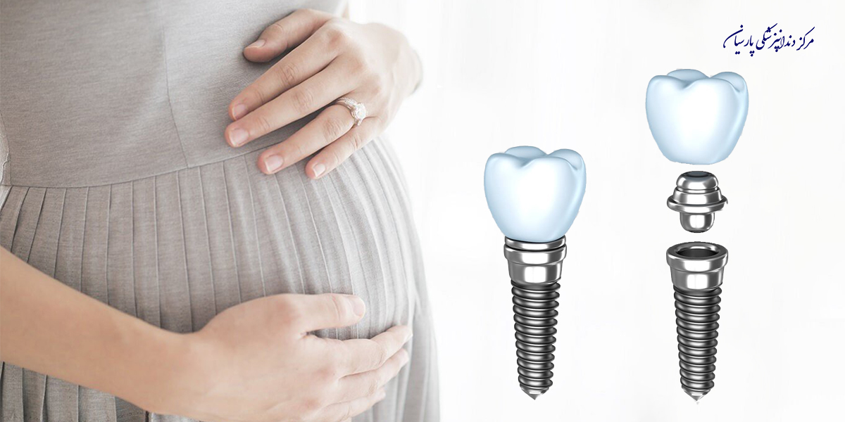 آیا انجام ایمپلنت در بارداری توصیه میشود ؟