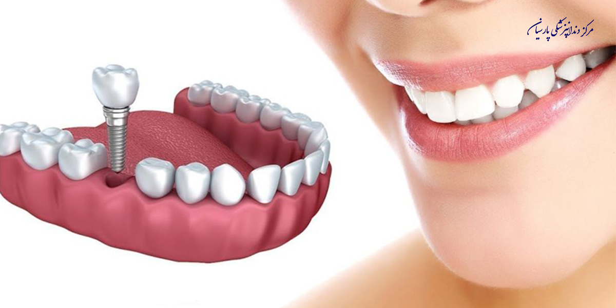 آیا عفونت ایمپلنت دندان درمان مناسبی دارد ؟