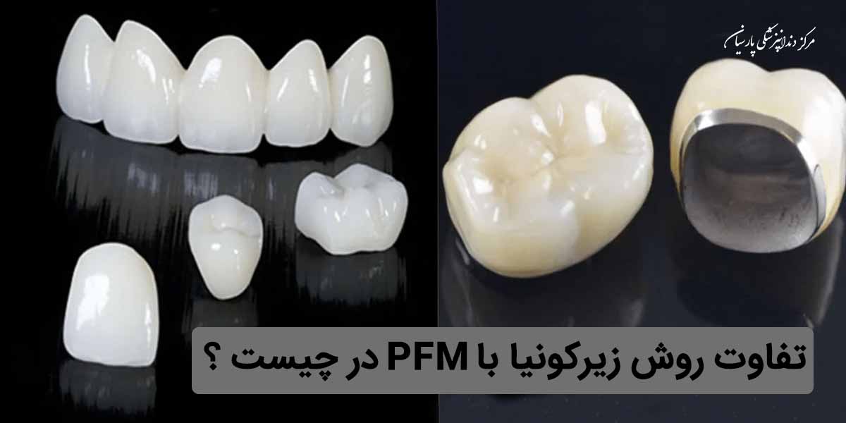 آیا میدانید تفاوت روکش زیرکونیا با PFM در چیست ؟