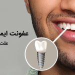 آیا میدانید علت عفونت ایمپلنت دندان چیست ؟