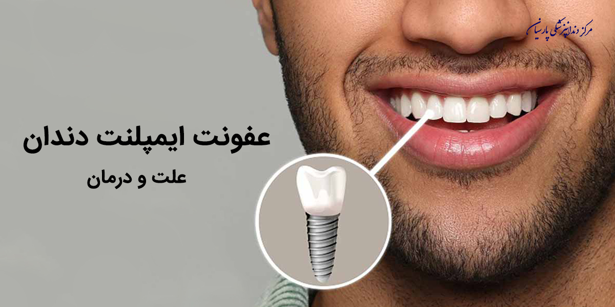 آیا میدانید علت عفونت ایمپلنت دندان چیست ؟