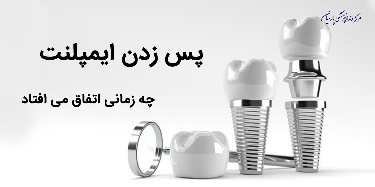 آیا میدانید پس زدن ایمپلنت چه زمانی اتفاق می افتد ؟