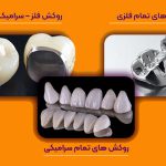 از تفاوت روکش زیرکونیا و PFM چه اطلاعاتی دارید ؟