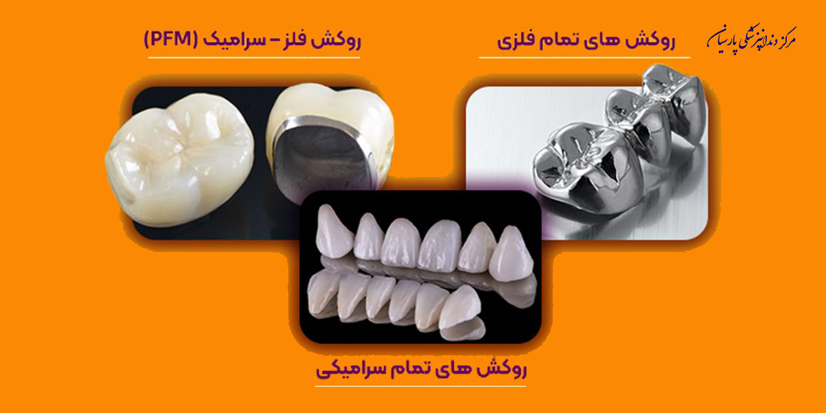 از تفاوت روکش زیرکونیا و PFM چه اطلاعاتی دارید ؟