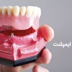 اوردنچر بر پایه ایمپلنت یعنی چه ؟